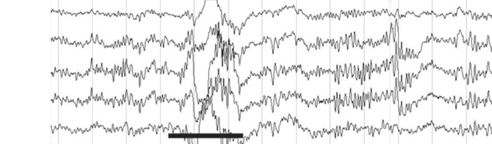 The following convention is used to define EEG frequencies: beta is greater than 13 Hz; alpha is between 8 and 13 Hz; theta is between 4 and less than 8 Hz, and delta is the slowest activity at less