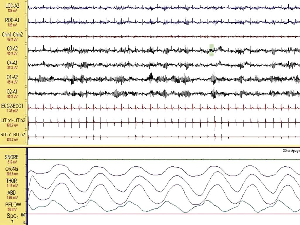Note the posterior dominant alpha frequency in the O1-A2 and O2-A1 leads (3). An electrocardiogram (ECG) artifact is noted in the electro-oculogram (EOG), EEG, and EMG leads (4).