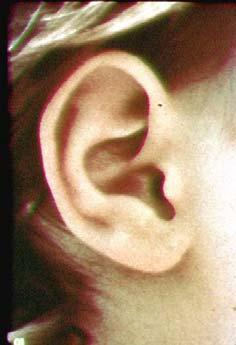 blue area- Great auricular nerve Antitragus Tragus Lateral surface red area-