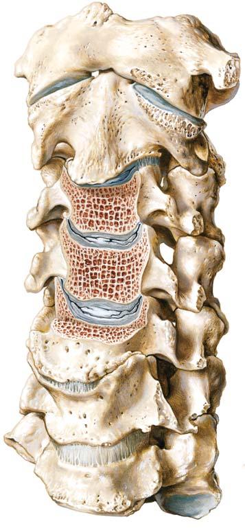 Cervical Spondylosis Axis (C2) Uncinate processes with loss of joint space in uncovertebral joint Spondylophytes (osteophytes) on uncinate processes Degenerative changes in cervical vertebrae (Atlas