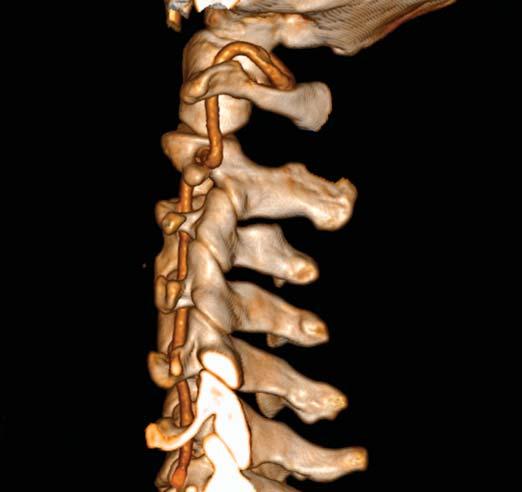 Vertebral Artery, Neck 1 Posterior arch of atlas (C1) Vertebral artery C5 transverse process Volume rendered display, CTA of the neck The intimate association of the vertebral artery to the cervical