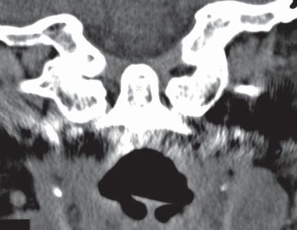 Craniovertebral Ligaments 1 Alar ligament Dens Epiglottis A Dens Transverse ligament of atlas Superior articular facet of atlas Spinal cord