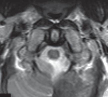 ligaments that connect the dens to the rim of the foramen magnum, stabilizing the atlanto-occipital relationship.