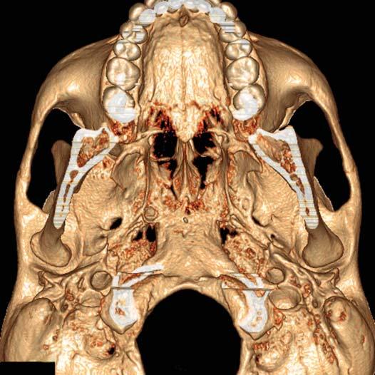 Skull, Basal View 1 Incisive foramen Hard palate Choanae Foramen ovale Foramen lacerum Foramen spinosum Carotid canal Mastoid process Jugular fossa Volume rendered display, maxillofacial computed