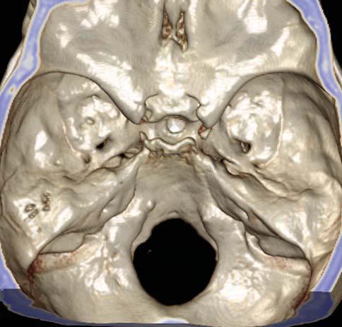 Skull, Interior View 1 Cribriform plate Hypophyseal fossa within the sella turcica Groove for middle meningeal artery Foramen ovale Foramen spinosum Foramen lacerum Internal acoustic meatus Volume