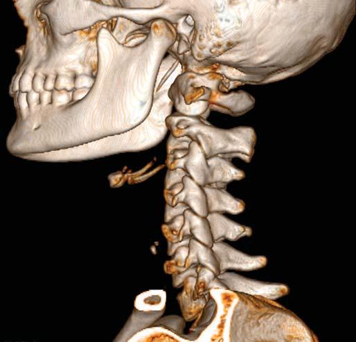 Upper Neck, Lower Head Osteology 1 External acoustic meatus Styloid process Mental foramen Hyoid bone Volume rendered display, maxillofacial CT The lesser horn of the hyoid bone is attached to the