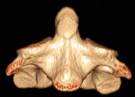 Axis (C2) 1 Dens (odontoid process) Superior articular facet for atlas Anterior arch Inferior articular facet for C3 Volume rendered CT scan, axis The dens is embryologically the vertebral body of