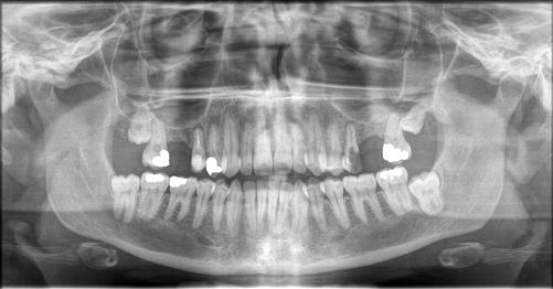 Styloid process Soft palate Condyle of mandible Condylar process Zygomatic arch Coronoid process Floor of the orbit Nasal