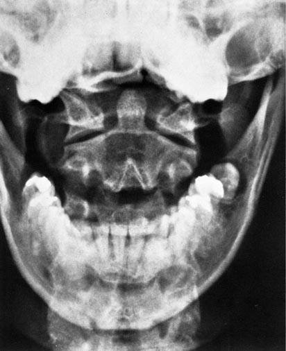 Posterior Arch of Atlas (Inferior Margin) Right Transverse Process of Atlas Right Lateral Atlantoaxial Articulation Spinous Process of Axis (Bifid) Inferior Dental Arch Body of Mandible Body