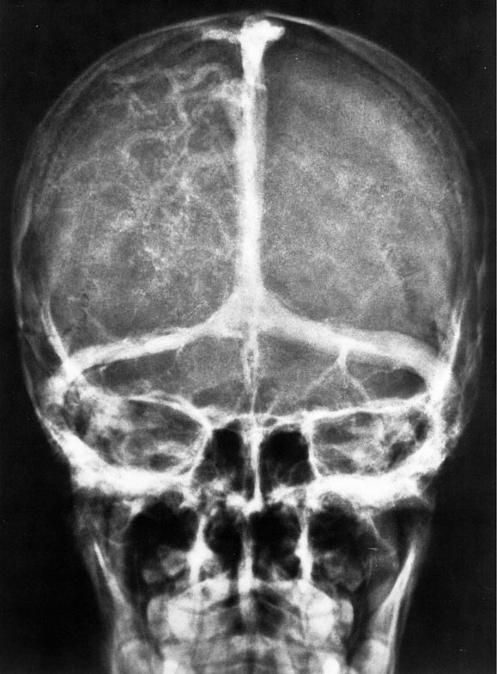 Superior Cerebral Veins Superior Sagittal Sinus Confluence of