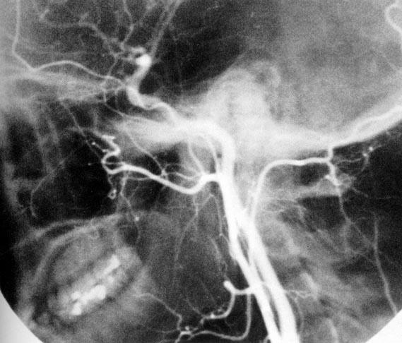 Middle Meningeal Artery Maxillary Artery External Carotid Artery Facial Artery Superior