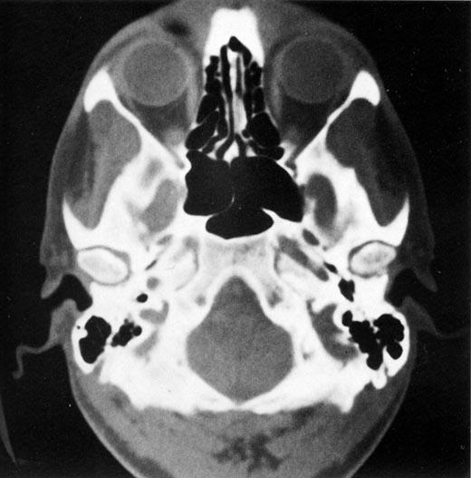 Nasal Spine of Frontal B Right Eyeball Frontal Process of R Zygomatic Bone Right Ethmoidal Air Cells Right Temporal Fossa Rt G Wing of Sphenoid B Sphenoidal Sinus Zygomat Pro of R Temp B Right Head
