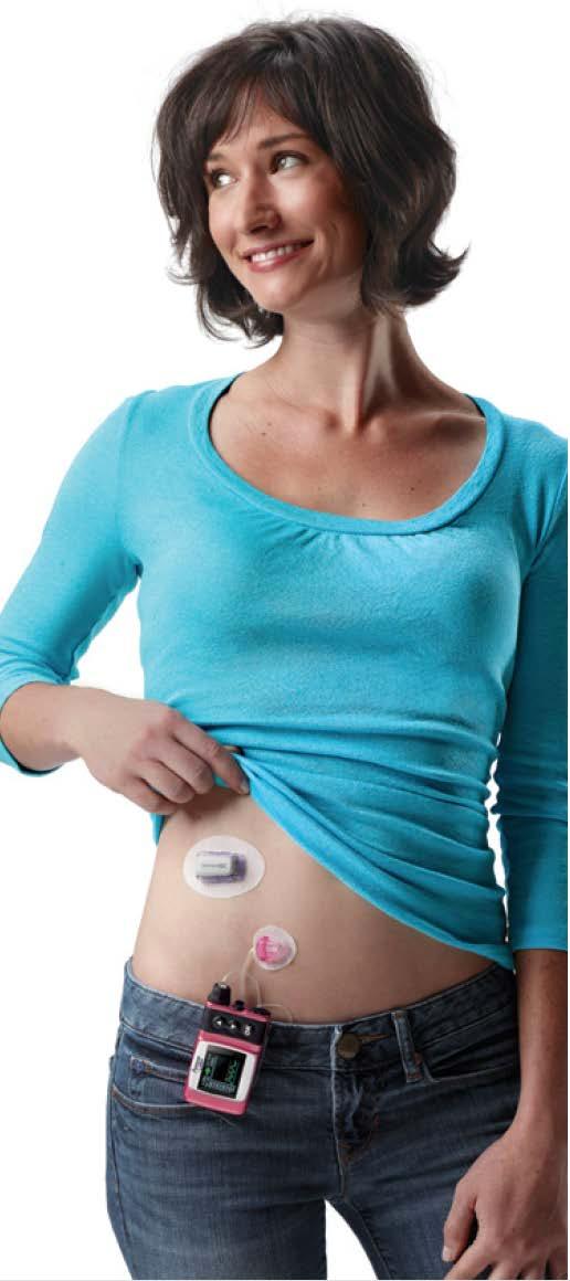 Sensor site selection and preparation. After using the Dexcom G4 PLATINUM CGM for some period of time, people often have questions about site selection and preparation.