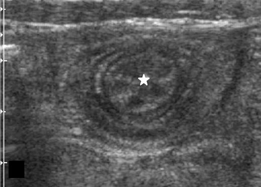 Scale segment distance, 5 mm Fig. 15 3-year-old girl with asymptomatic cystic fibrosis and small-bowel intussusception.
