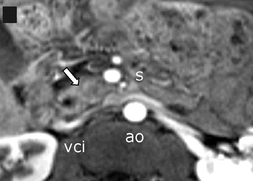 ao = aorta, s = superior mesenteric artery, vci = inferior vena cava.