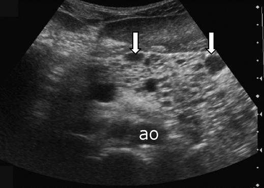 , xial contrast-enhanced T1-weighted MR image obtained at same level as shows intermixed low signal intensity (arrow) representing pancreatic