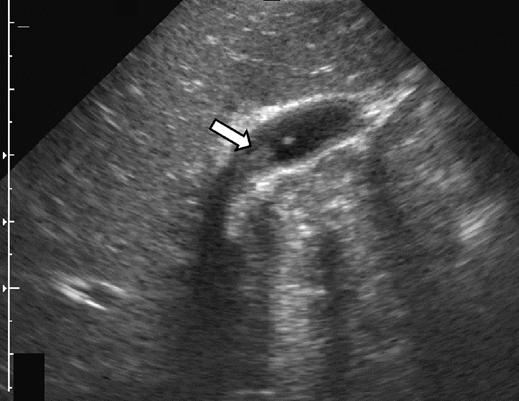 Small, empty gallbladder (G) (arrow) is 25 mm long. Scale segment distance, 10 mm. Fig. 10 9-year-old boy with sludge (arrow) within small gallbladder.