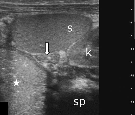 duct (arrowhead) beside hepatic artery (star) and portal vein (arrow). Scale segment distance, 5 mm.