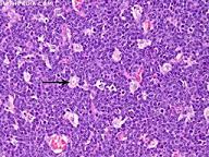 Burkitt lymphoma Most aggressive of all lymphomas Affects children (usually 5-10 yrs) and accounts for 30-40% of childhood lymphomas Affects adults (usually 30-50 yrs),