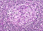 Mantle cell lymphoma (MCL) Develops in the outer edge of a lymph node called the mantle zone 6% of NHLs, usually affecting men over age 50 Often have many lymph nodes, one or more