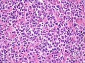 T Cell lymphoma Account for 10% of NHLs Peripheral T-cell lymphoma general term referring to 10+ subtypes Peripheral T-cell lymphoma not