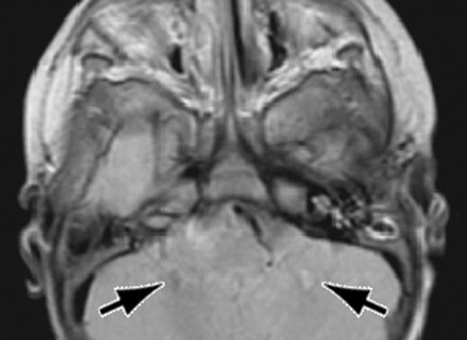 MRI of CSF Fig. 18 Healthy 2-year-old boy.