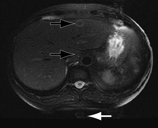 xial fast spin-echo T2 image shows bright ringshaped lesion (black arrows) in left lobe of liver due to ghosting of CSF motion.
