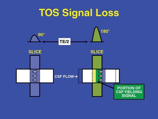 Lisanti et al. C Fig. 1 Schematic representation of factors involving occurrence and degree of time-of-flight (TOF) losses.