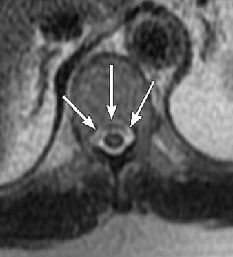 superior to foramen of Monro (arrows) secondary to time-of flight losses. Fig.