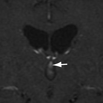 MRI of CSF Fig. 7 63-year-old man with vertigo.