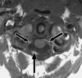 enhancement (FRE) on entry slice. FRE rapidly diminished on deeper coronal slices (not shown.) Fig. 9 Healthy subject.