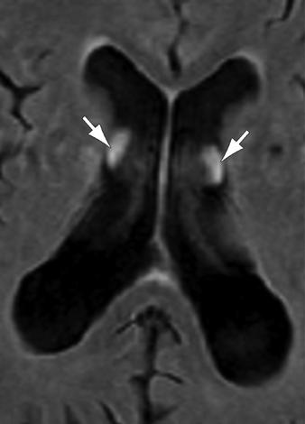 periphery of subarachnoid space (arrows) due to flow-related enhancement, No saturation band was applied.