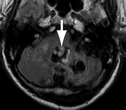 Lisanti et al. Fig. 11 57-year-old man with remote history of left cerebellar astrocytoma resection.