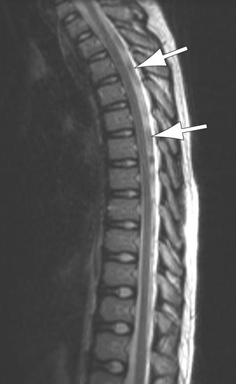 MRI of CSF Fig. 13 25-year-old man with thoracic spine pain.