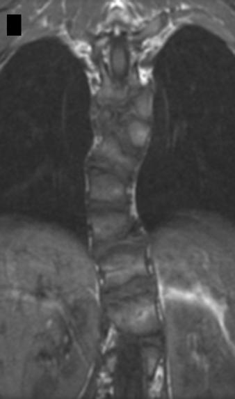 Corresponding sagittal T1-weighted image (not shown) shows normal dark CSF signal. Fig.
