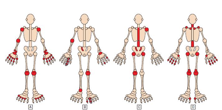 Polyarthritis o Patterns of joint involvement in different forms of polyarthritis: Rheumatoid arthritis Psoriatic arthritis Ankylosing spondylitis Osteoarthritis Walker, BR, Colledge, NR,