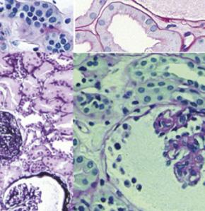 (M) PAS staining of the same glomerulus as shown in