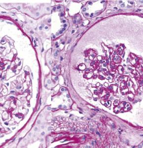 space, wrinkled GBM, glomerular collapse, and FGGS in