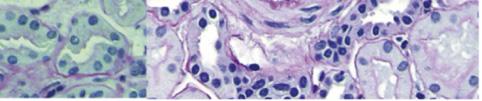 (N) Three glomeruli, including one glomerulus with PMBS,
