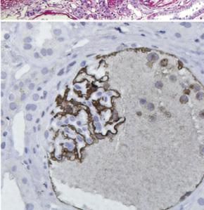 and one glomerulus with a collapsed tuft, global