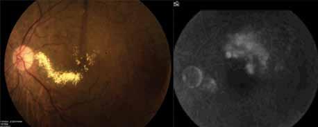 Applying New Data to Improve the Standard of Care in Retinal Diseases Case 2 A 66-year-old woman presented with BRVO and macular edema and lipid.