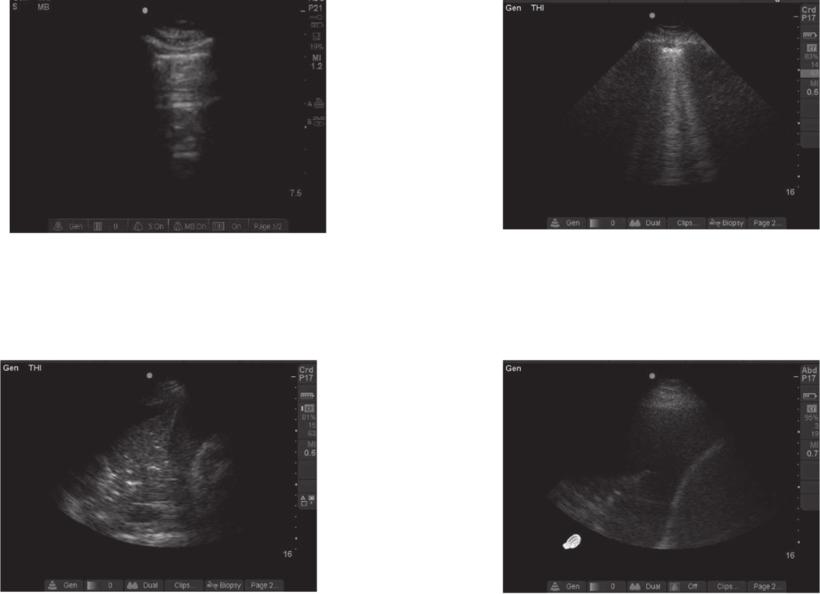 Figure 2. Ultrasound thoracic patterns. A, Normal aeration pattern. B, Alveolar-interstitial pattern. C, Alveolar consolidation pattern. D, Pleural effusion.