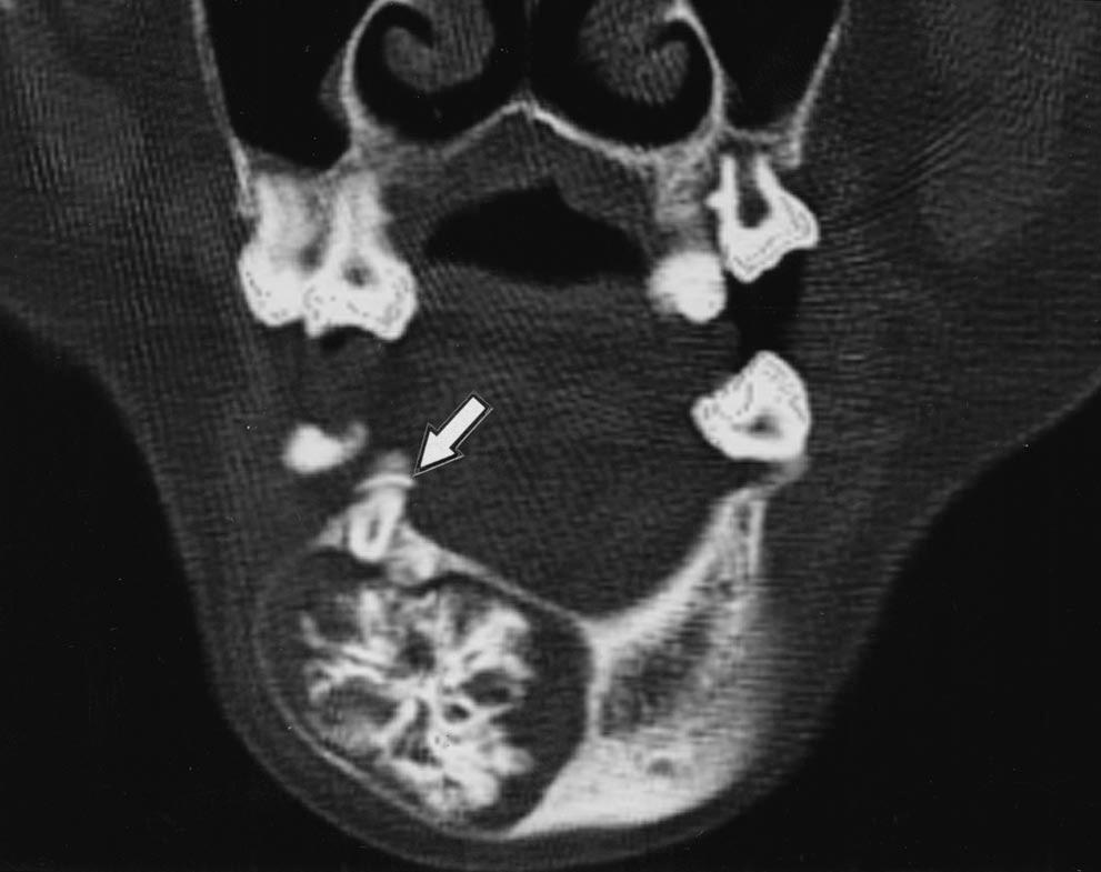 Pictorial Essay CT of Calcifying Jaw one Diseases Koichi Yonetsu 1 and Takashi Nakamura Downloaded from www.ajronline.org by 46.3.204.207 on 01/08/18 from IP address 46.3.204.207. Copyright RRS.