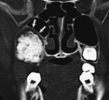 , Coronal CT scan shows maxillary sinus floor (arrows) expanded and lifted upward by tumor. Fig. 2. 17-year-old girl with ameloblastic fibroodontoma in right mandible.