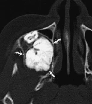 , Coronal CT scan shows involvement of second premolar tooth in osteolytic area (arrow ). and mesodermal origin such as enamel, dentin, cementum, and pulp tissues.