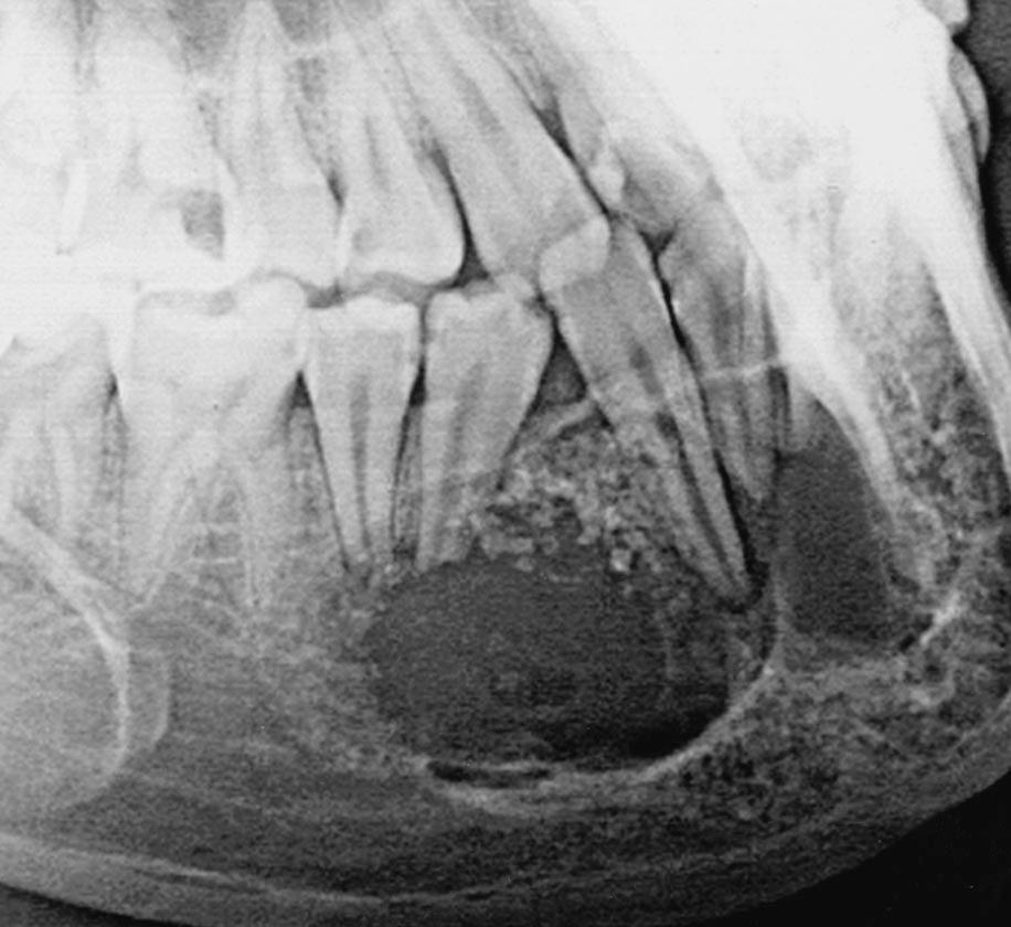 , xial CT scan shows irregular calcification around impacted first premolar tooth.