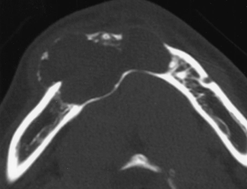 17-year-old girl with calcifying odontogenic cyst in mandible.