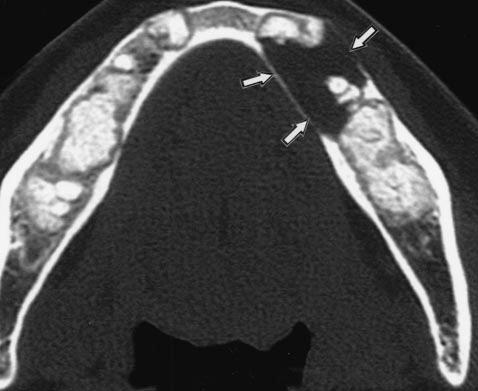 , xial CT scan shows multiple discrete calcified masses in tooth-bearing regions of mandible.