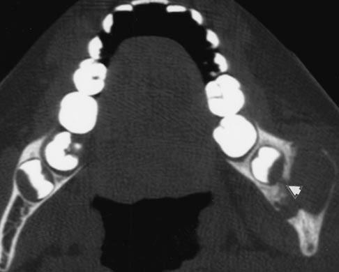 xial CT scan shows large mass with varying degrees of calcification occupying entire body of mandible. Fig. 8.