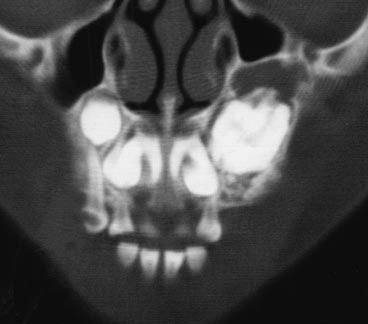 Fig. 9. 5-year-old boy with complex odontoma in left maxilla.